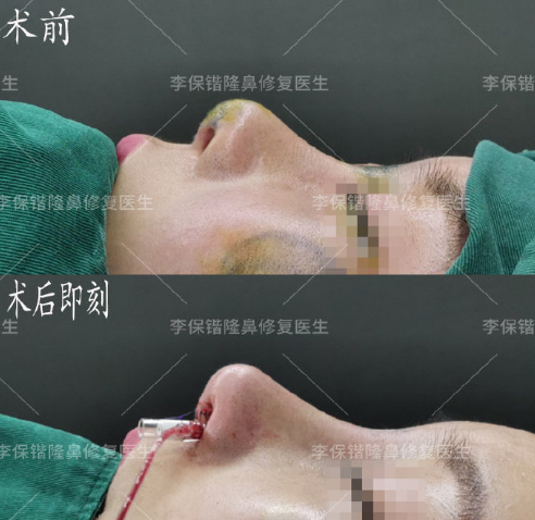 杭州鼻子修复最好的医生是谁