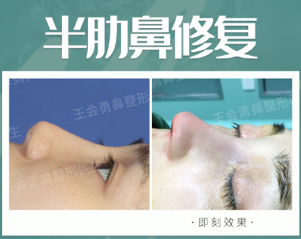 上海最好的鼻子修复医生预约排名大全