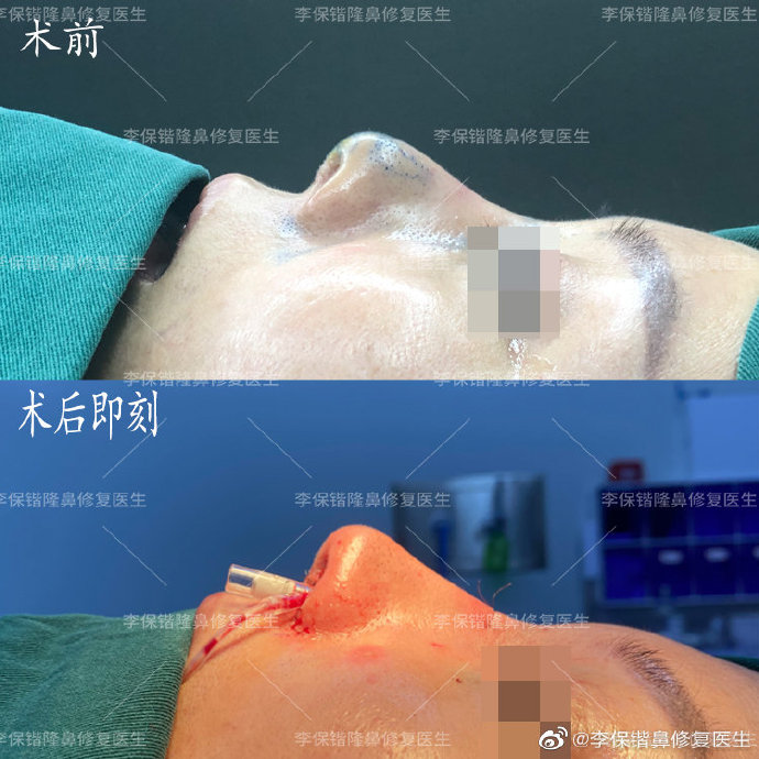 杭州修复鼻子最好的医生是哪个