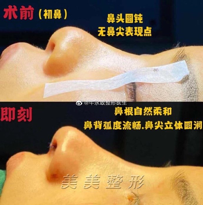 郑州最出名的鼻整形医生是哪个？郑州隆鼻专家前十名排行榜