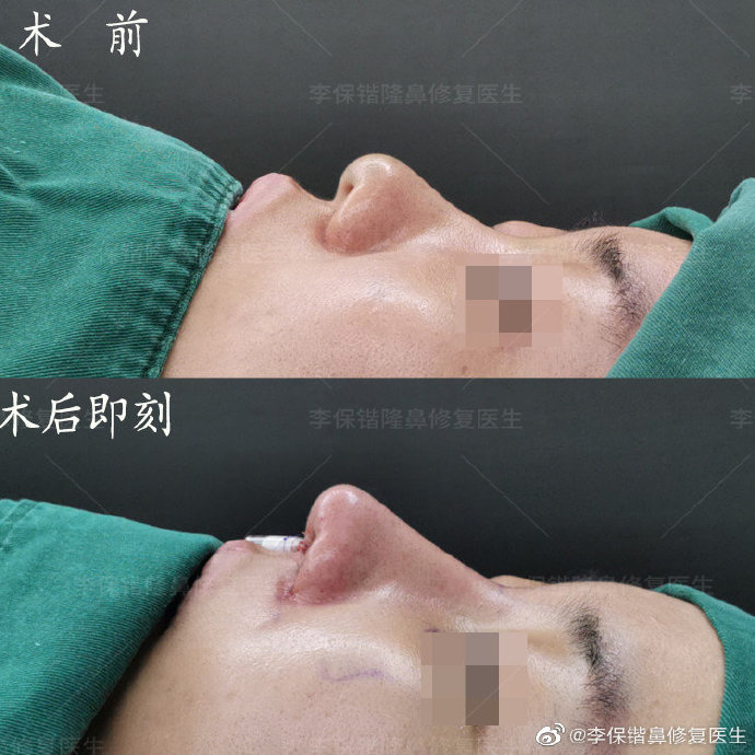 杭州鼻综合修复手术医生排名