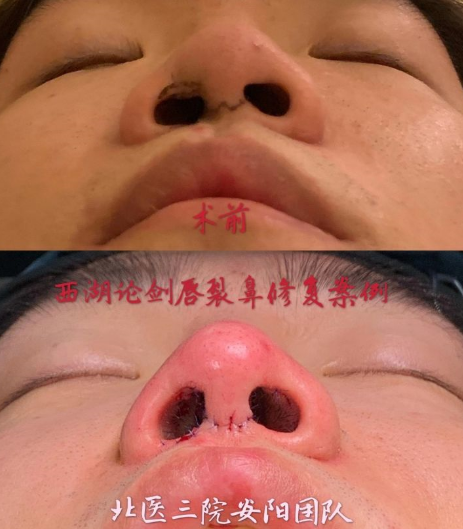 中国鼻修复专家哪个最厉害