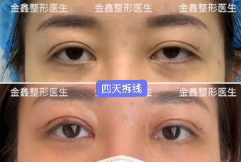 深圳有哪些做双眼皮修复的医生预约排名大全
