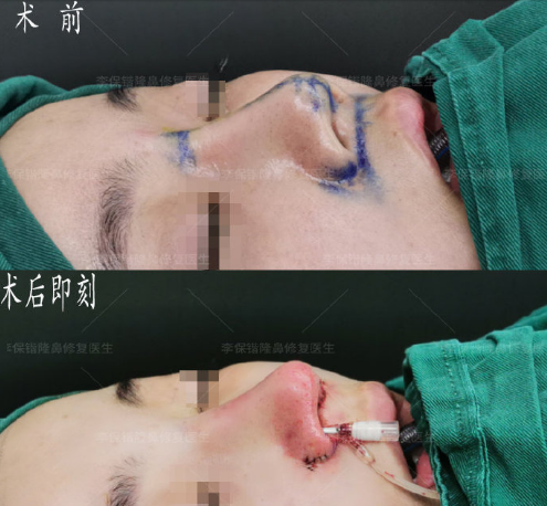 杭州鼻综合修复手术哪个医生好？李保锴、刘军、薛旦、汪云峰、张龙