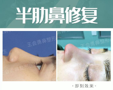 上海技术最好的鼻修复专家是谁？上海隆鼻修复医生预约排名