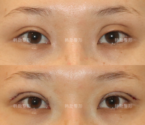 全国最有名的双眼皮修复医生 中国眼修复专家预约排名大全