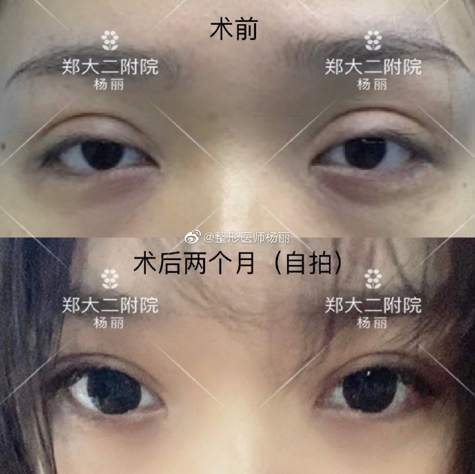 郑州做修复双眼皮好的医生是哪个