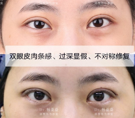 上海哪个医生双眼皮修复比较好？上海眼修复前十名预约排名