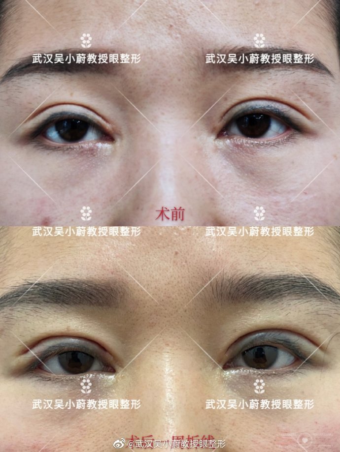 吴小蔚做双眼皮修复案例