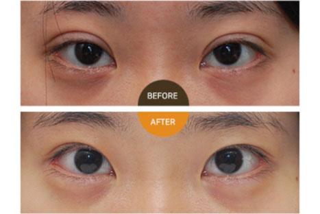 北京双眼皮修复比较好的医生有哪些