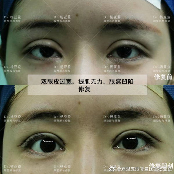 上海华美医院割双眼皮哪个医生最好