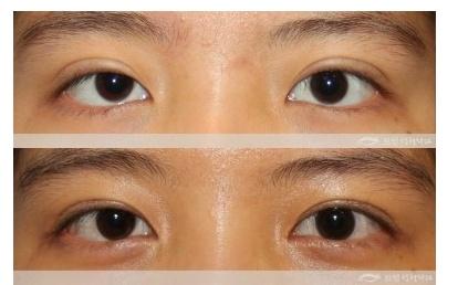 上海九院双眼皮修复哪个医生比较好？