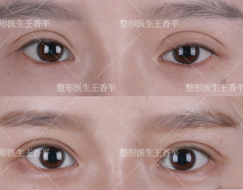 王香平做双眼皮和双眼皮修复怎么样